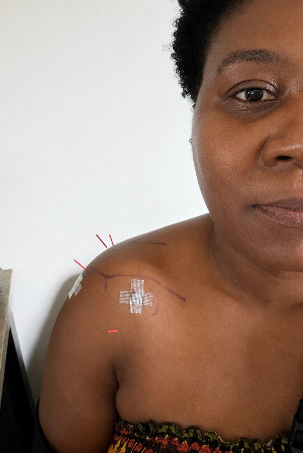 Valencie Exceus, AP, doing acupuncture on her own shoulder three days after surgery